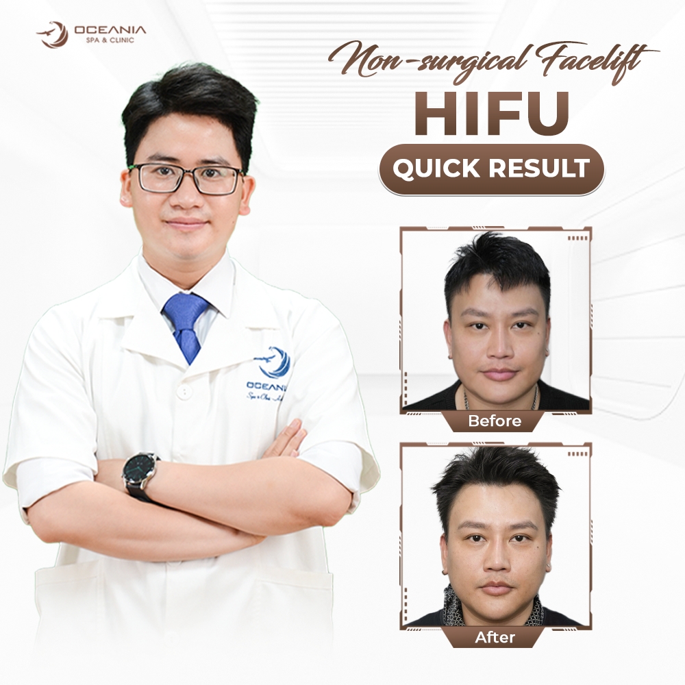 HIFU