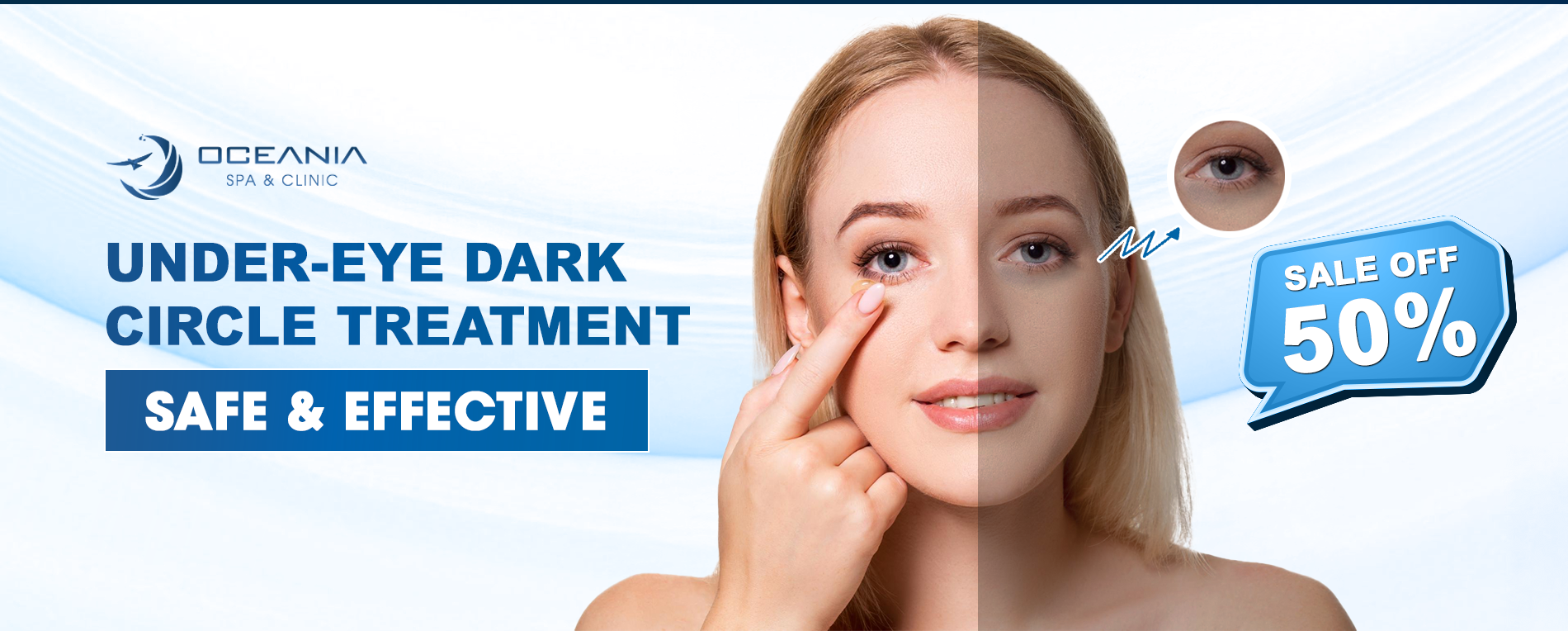 5 Best Treatments for Under-Eye Dark Circles
