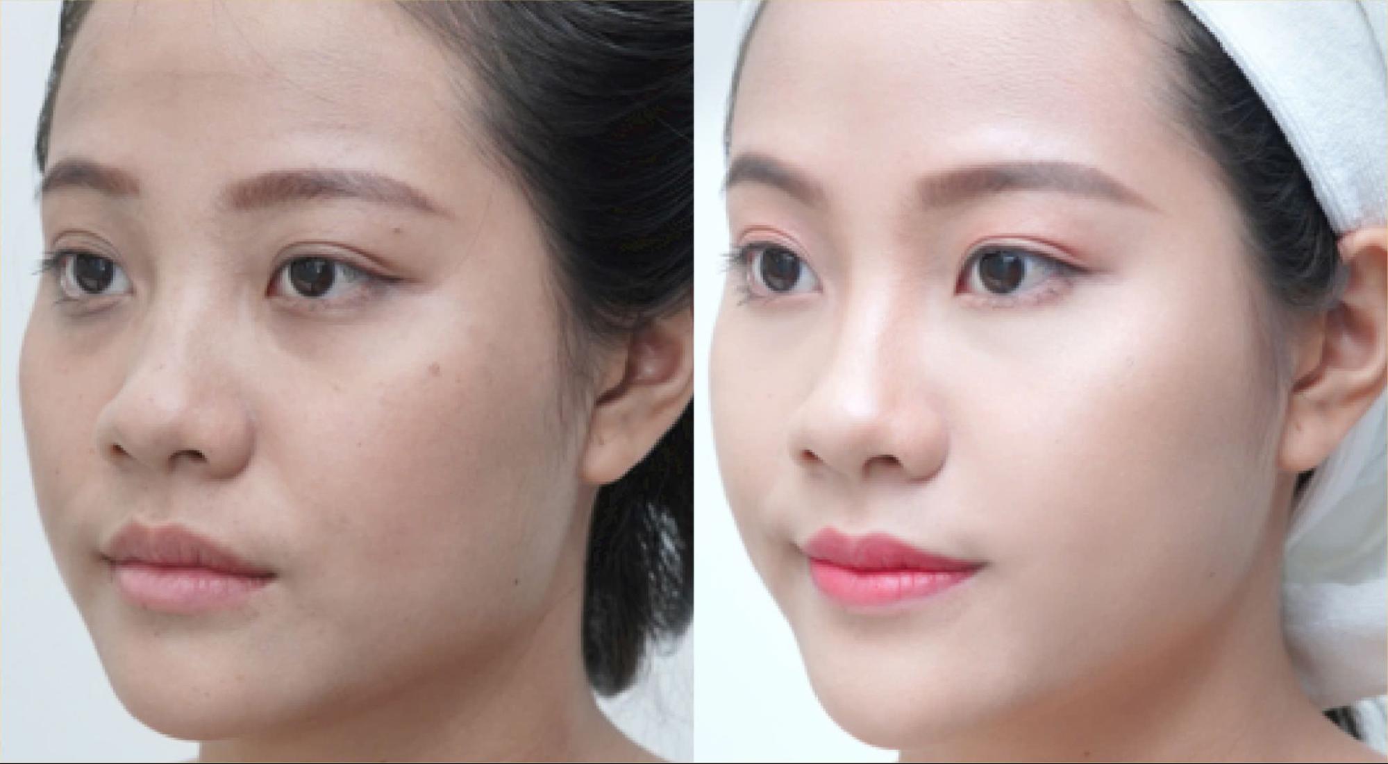 Benefits of Skin Rejuvenation Technology