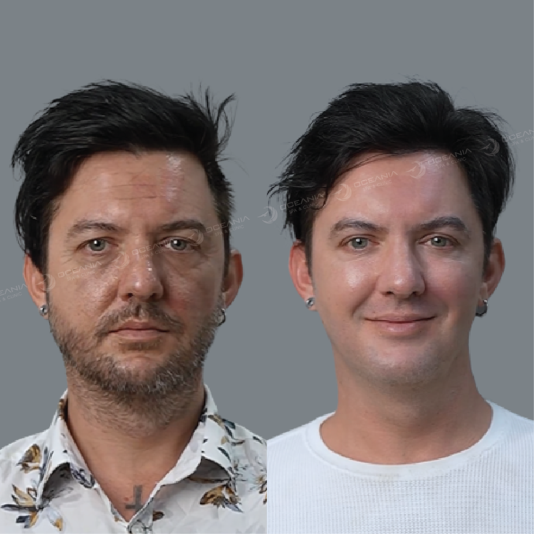 anh-before-after-hifu-07